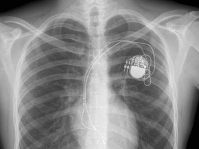 Эксперты обнаружили уязвимости в кардиостимуляторах