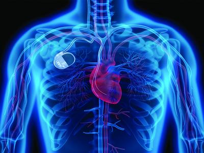 Взлом кардиостимуляторов может использоваться для шантажа